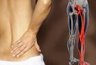 Nguyên Nhân Cách Chữa Đau Thần Kinh Tọa