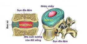 CÁCH CHỮA RÁCH BAO XƠ ĐĨA ĐỆM CHỈ 20 PHÚT