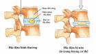 Xẹp đĩa đệm: Nguyên nhân, triệu chứng và hướng điều trị