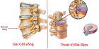 Nguyên nhân cách chữa bệnh gai cột sống