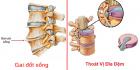 Nguyên nhân cách chữa bệnh gai đốt sống