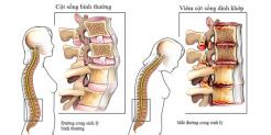 Nguyên nhân viêm cột sống dính khớp và cách chữa