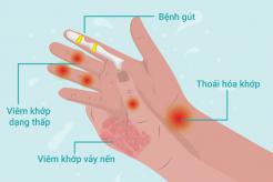 Chữa đau nhức xương khớp bàn tay, ngón tay thế nào