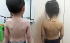 Cách chữa cong vẹo cột sống tại phòng khám Việt Đức
