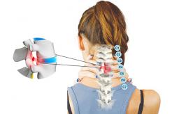 Chữa Gai Cột Sống Cổ Rất Dễ Dàng Không Khó Như Bạn Nghĩ