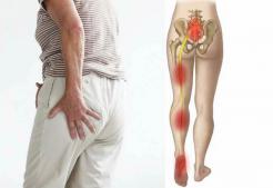 Nguyên Nhân Cách Chữa Đau Thần Kinh Tọa